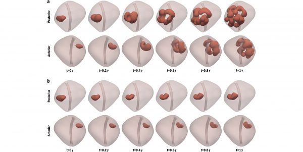 Ricercatori UniPV usano la simulazione al computer per comprendere la meccanica della crescita dei tumori alla prostata